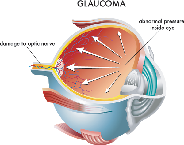 glaucoma treatment in valley stream